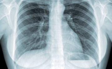 Tüdőszűrés Budakalászon