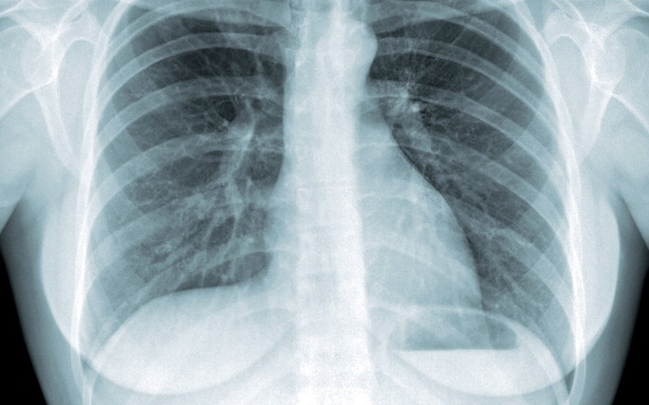 Tüdőszűrés Budakalászon